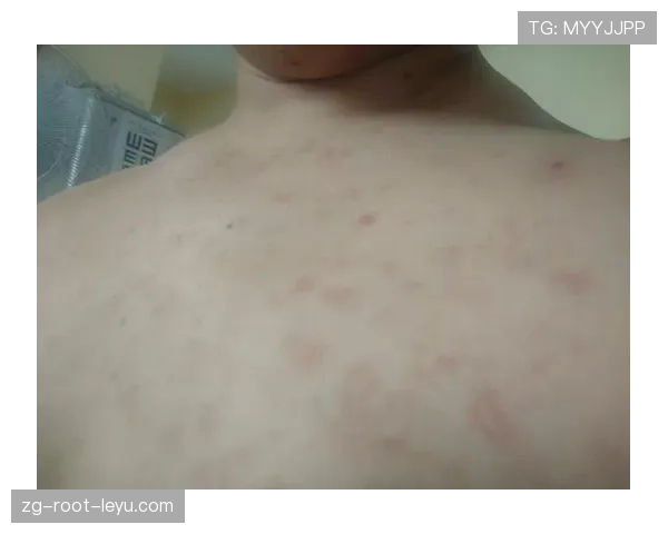 热水澡后全身通红的放松，热水澡后皮肤发红发痒